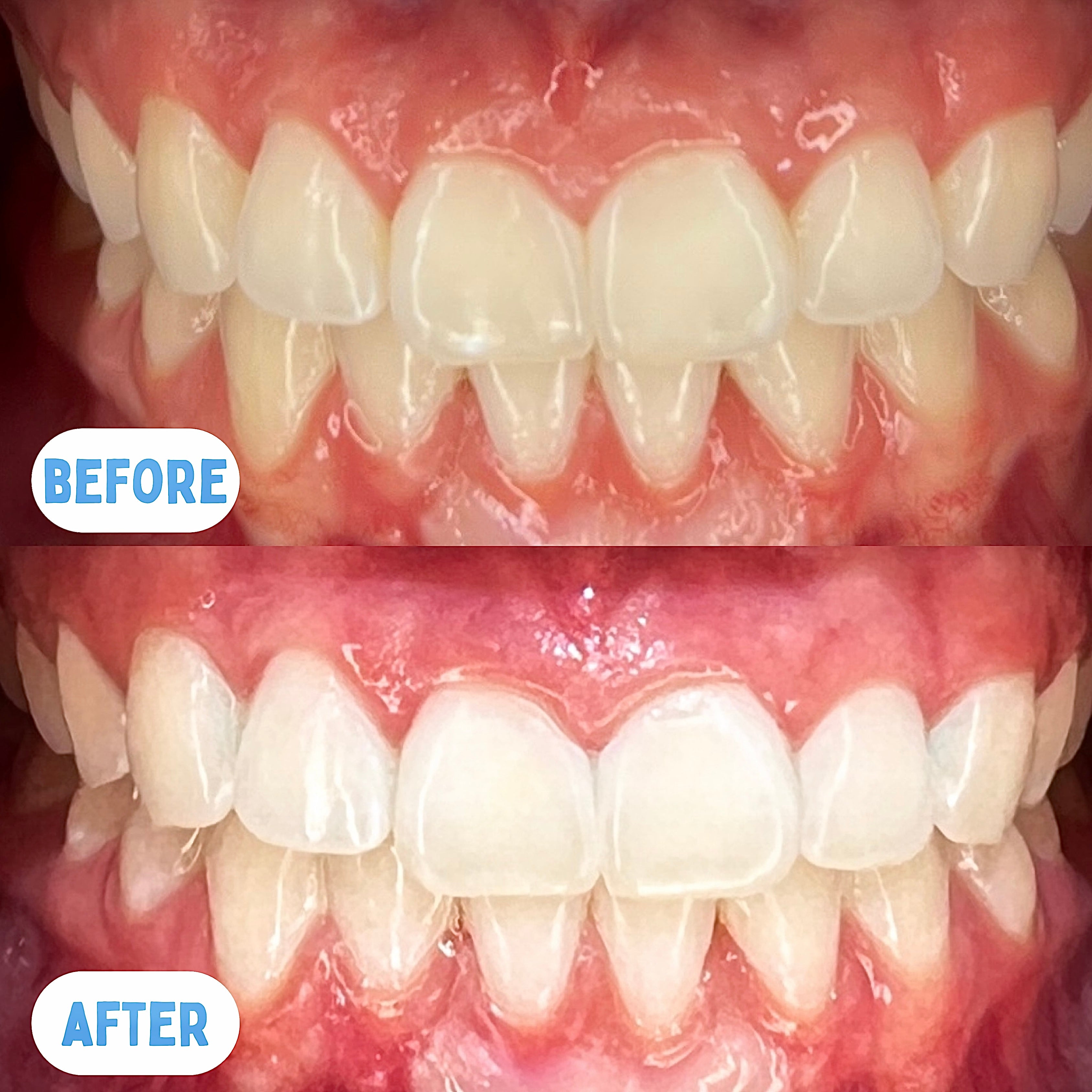 Teeth Whitening Treatment